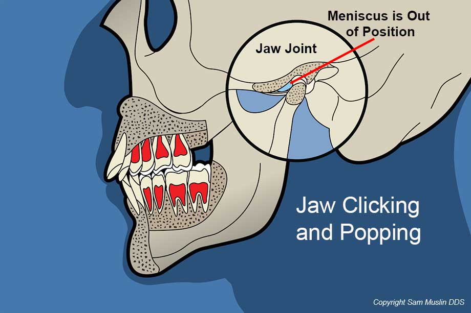 How To Get Rid Of Your Jaw Popping