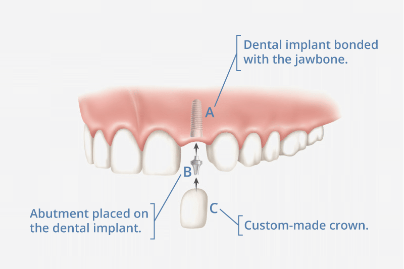Categorie Geavanceerd Vlak De meest uitgebreide gids voor tandheelkundige implantaten [De Ultieme Gids]