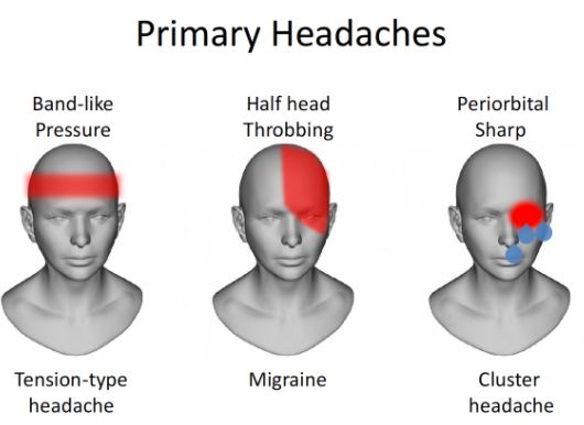 types of headaches illustration boston tmj specialist