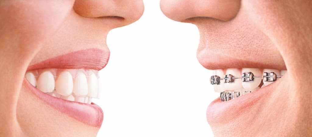 Europa Leidinggevende fundament Invisalign vs. Braces: Hoe ze te vergelijken en wat je moet weten