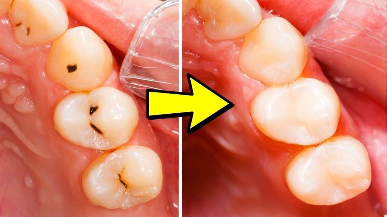 How to Get Rid of Cavities How long does it take to fill a cavity featured image