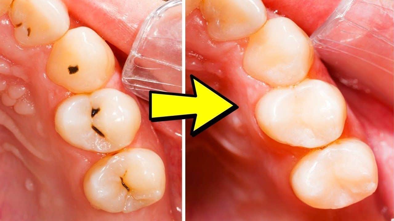 How-to-Get-Rid-of-Cavities-How-long-does-it-take-to-fill-a-cavity-featured-image.jpg