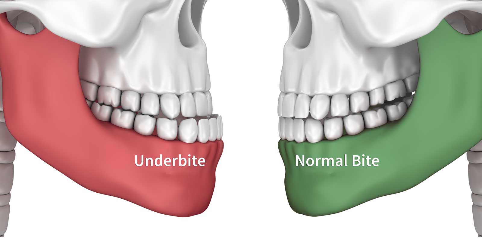 tmj surgery consideration also should include lefort and bsso as potential options