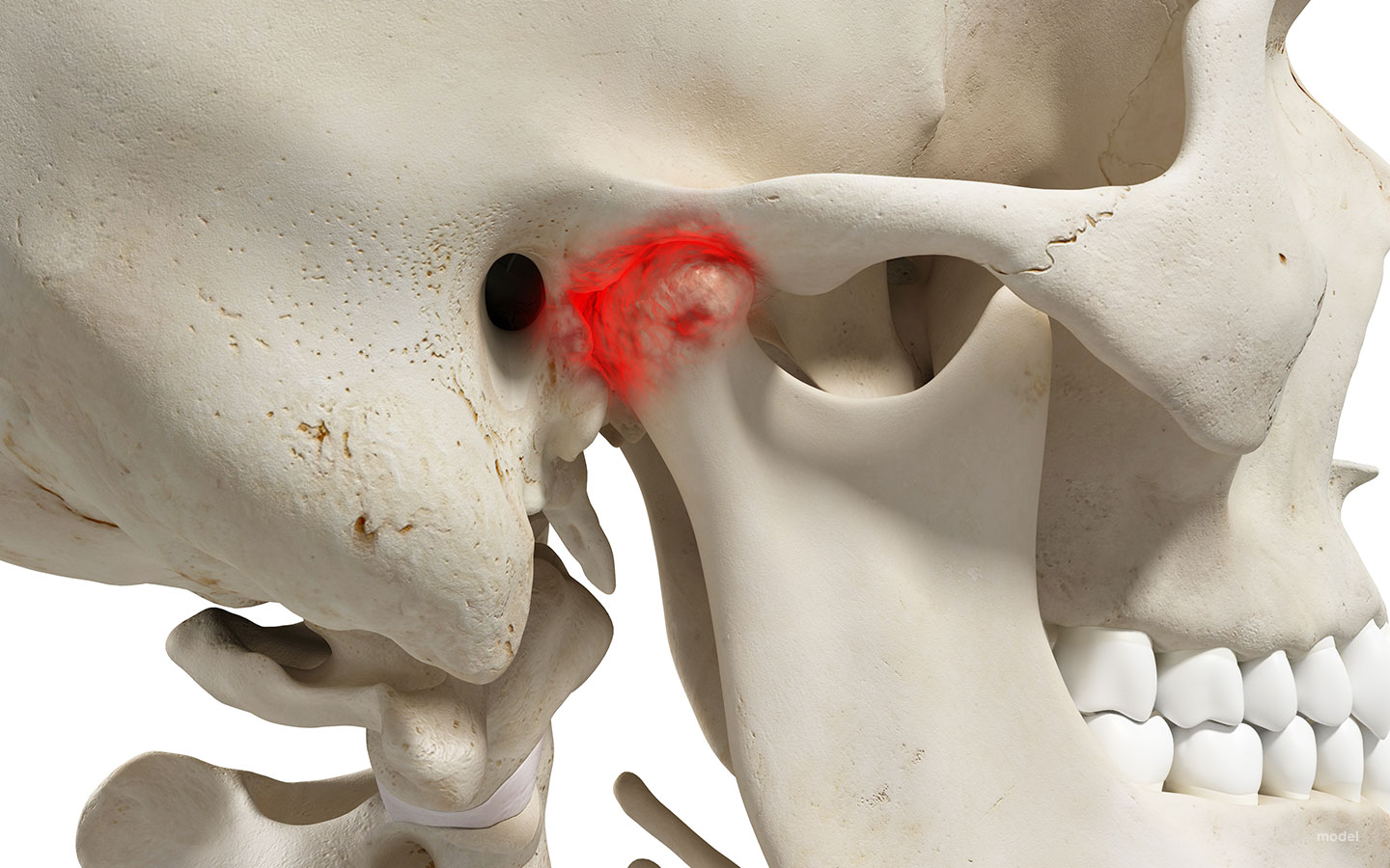 cirurgia de ATM imagem em destaque
