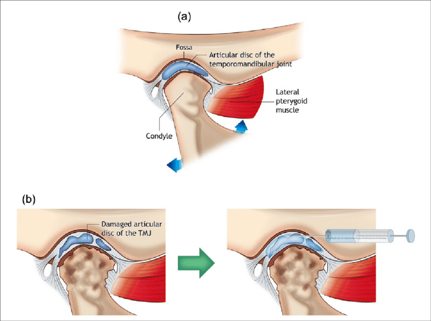 tmj surgery with Arthrocentesis