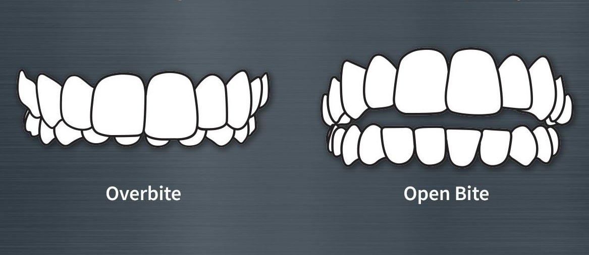 Overbite: What is it and Why Correcting an Overbite is Important