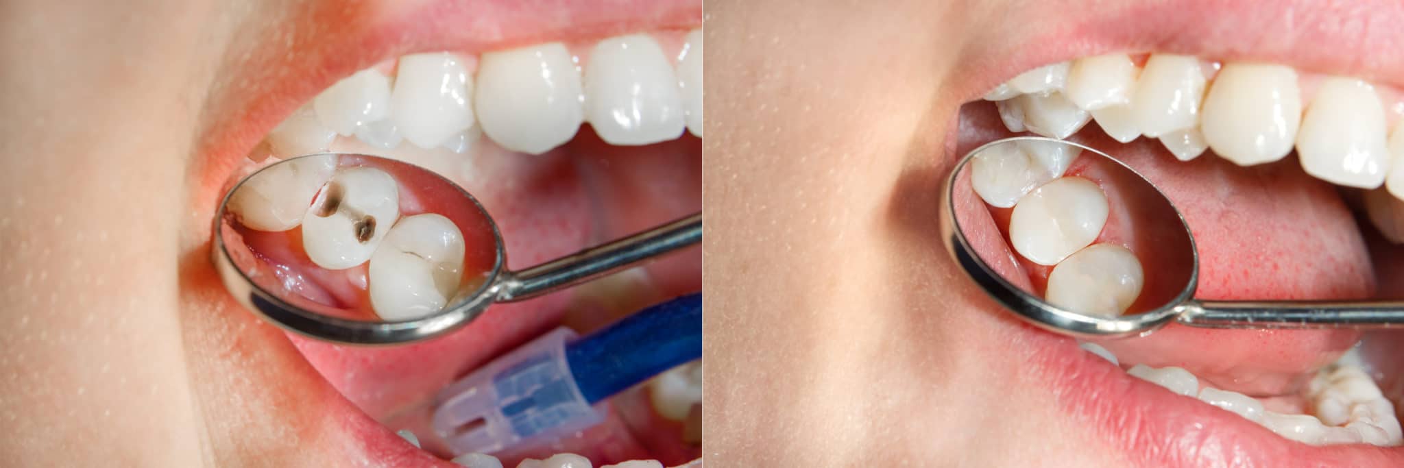 what is tooth decay and can you reverse a cavity