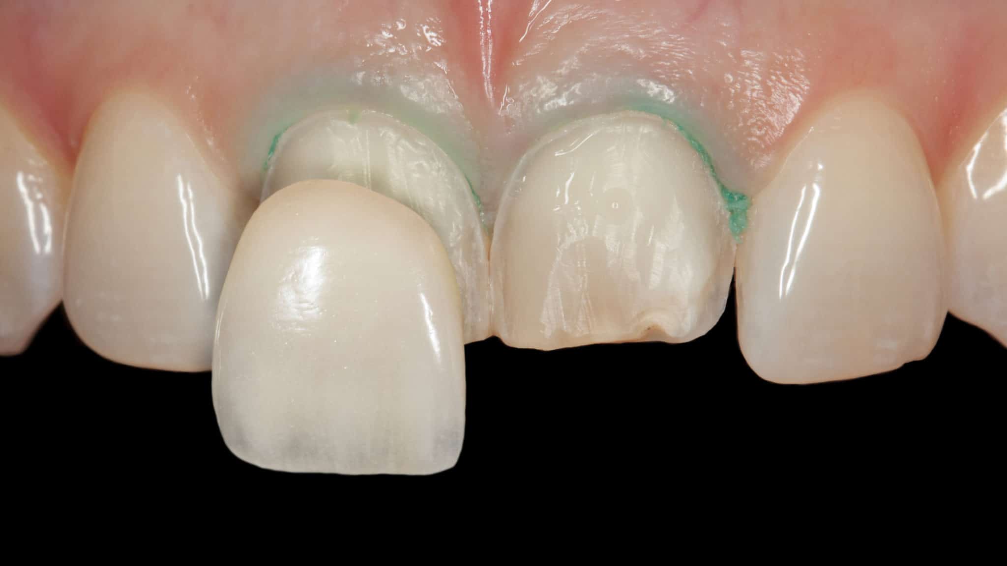 veneers can straighten teeth and also help improve tmj disorder