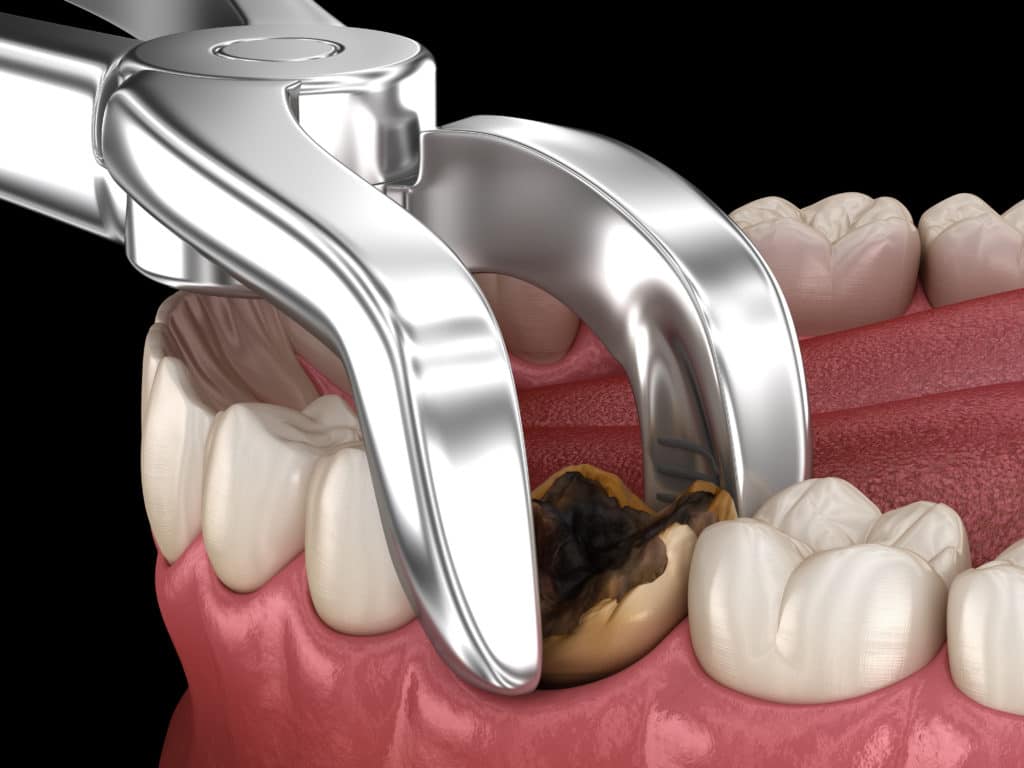 Complexity of Tooth affects how long a tooth extraction takes