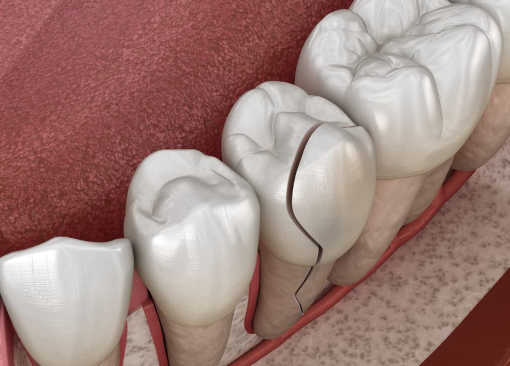 răng đau khi tôi cắn từ răng bị nứt