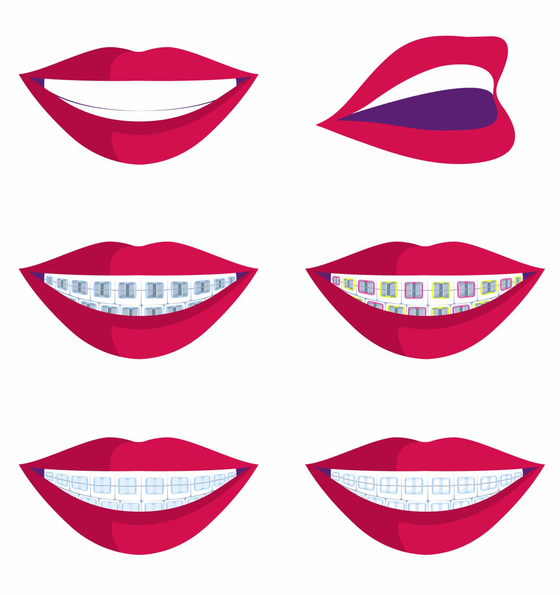 types of braces and how to straighten teeth illustation featured image